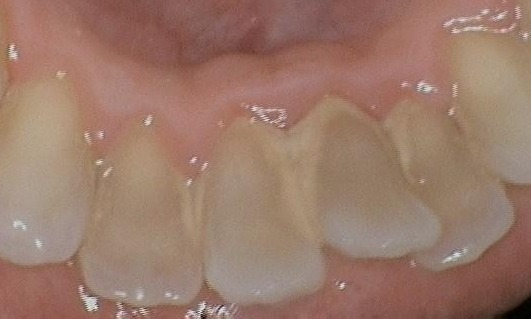 dental implants glenview