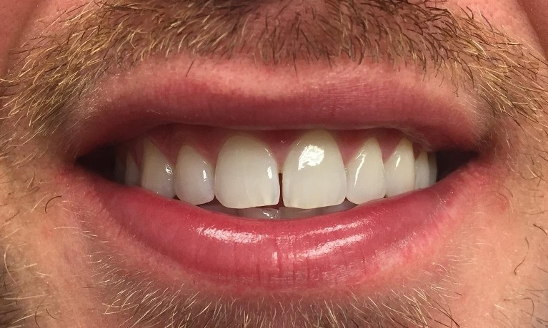dental implants glenview